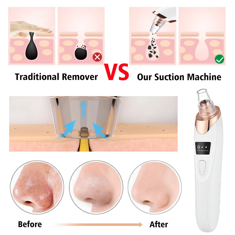 “5-in-1 Rechargeable Blackhead Remover – Vacuum Suction, Acne & Pore Cleaner with LED Display”